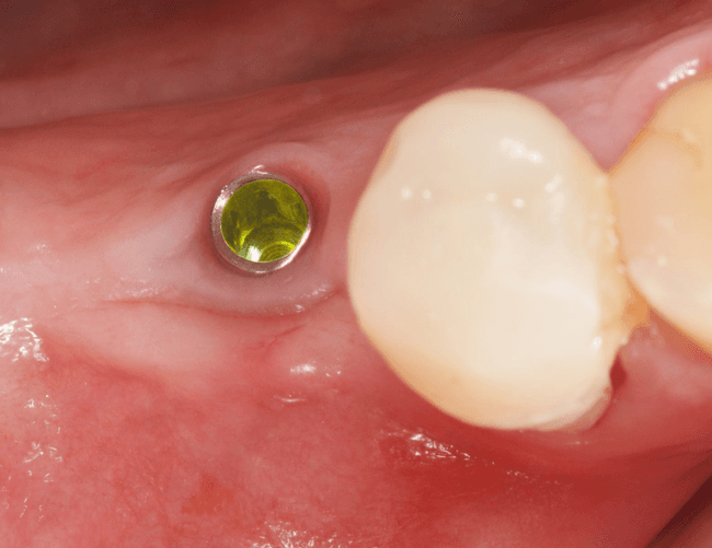 Klinische Situation mit BioniQ S2.9 Implantat im Frontzahnbereich